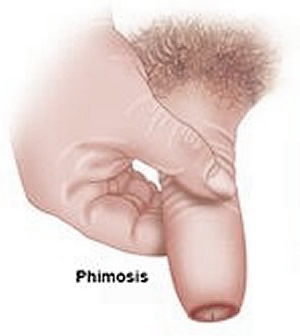 Phimosis Treatment